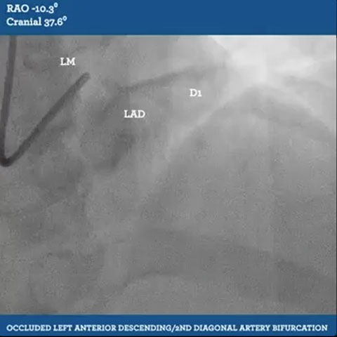 Occluded Left Anterior Descending/2nd Diagonal Artery Bifurcation